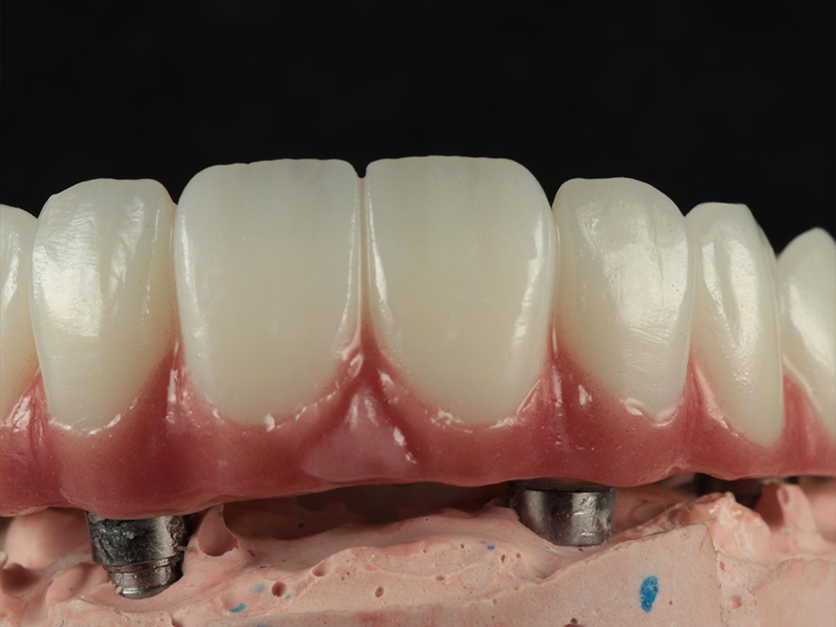 Dental restoration made with KEKR Aurora 4D zirconia
